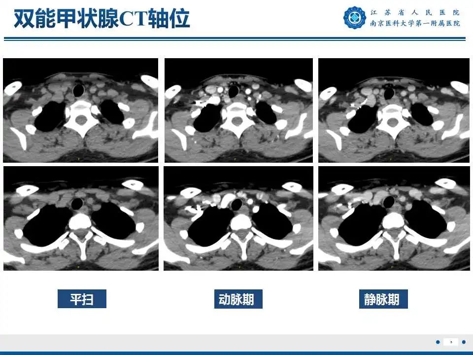 【PPT】甲状腺乳头状癌颈部淋巴结转移-6