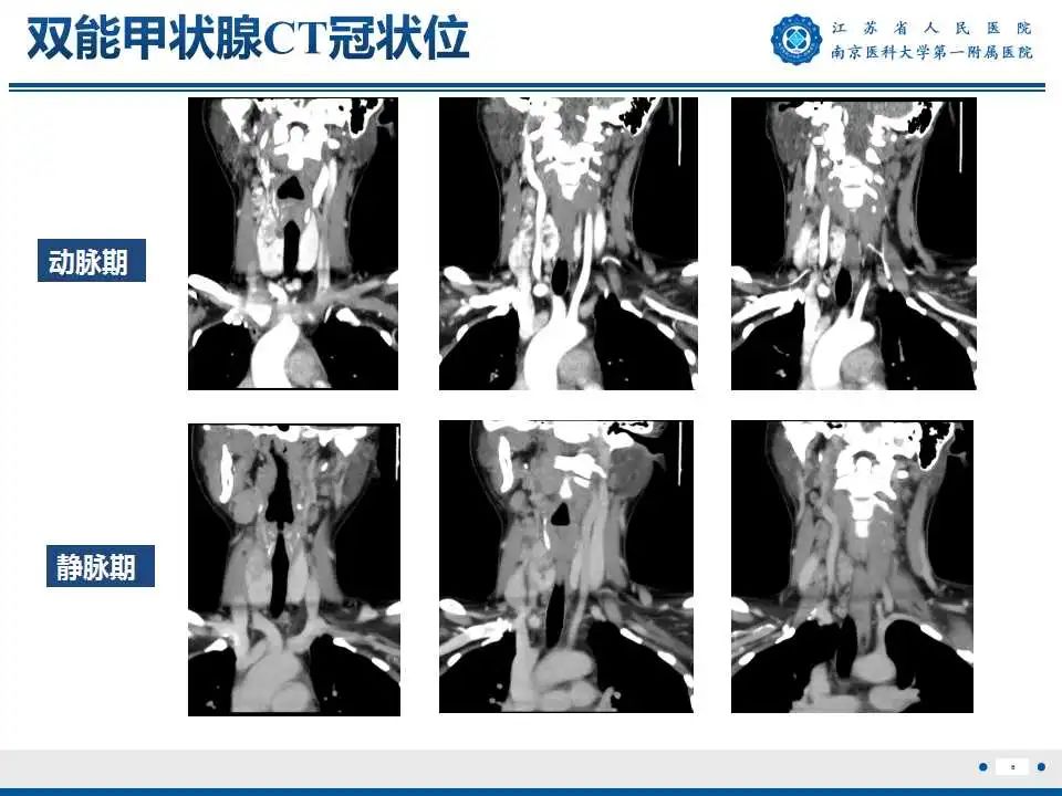 【PPT】甲状腺乳头状癌颈部淋巴结转移-7