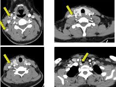 <b>甲状腺乳头状癌颈部淋巴结转移</b>