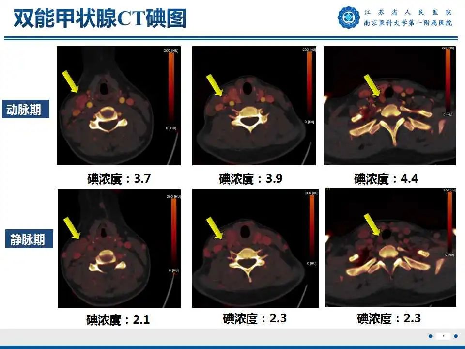 【PPT】甲状腺乳头状癌颈部淋巴结转移-8