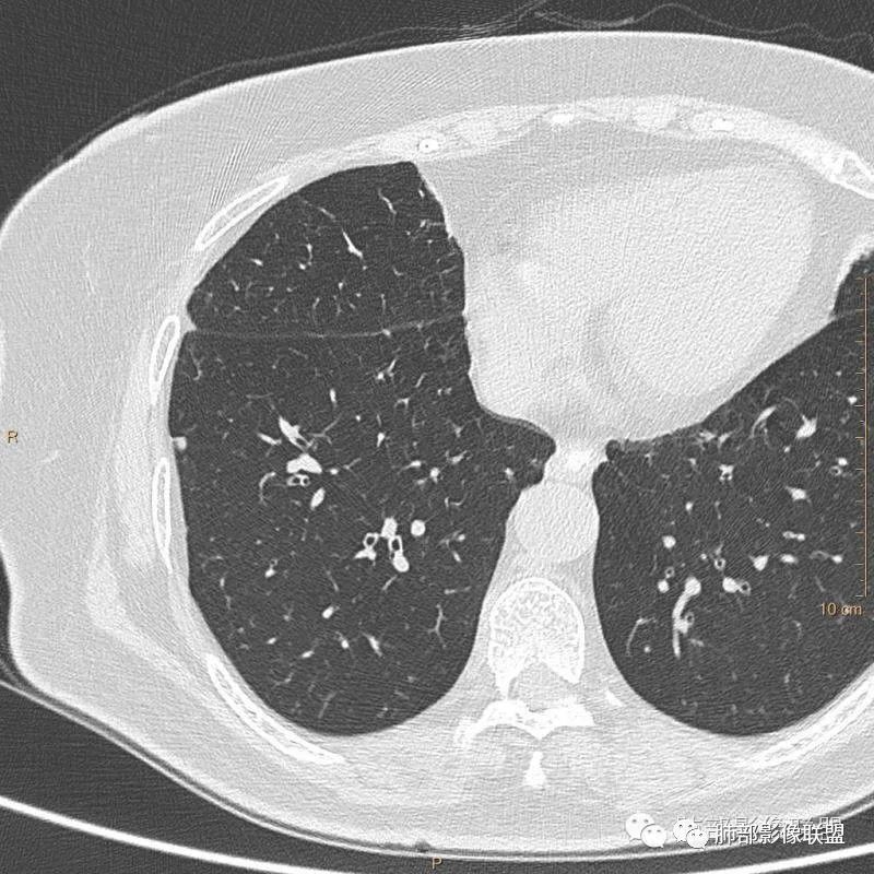 【病例】肺内淋巴结7例CT影像诊断要点-2