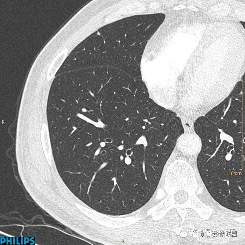 【病例】肺内淋巴结7例CT影像诊断要点-3