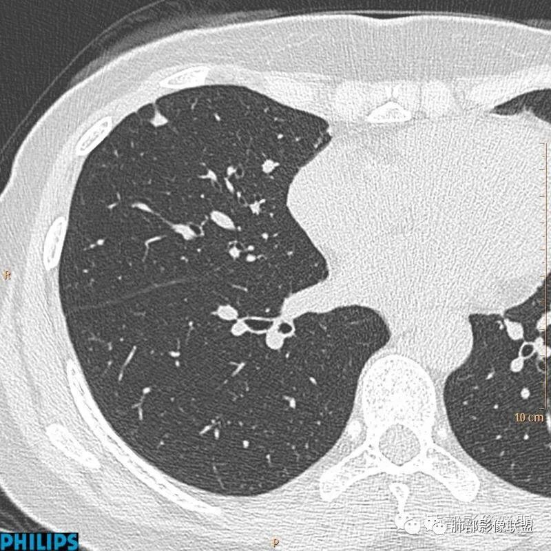 【病例】肺内淋巴结7例CT影像诊断要点-5
