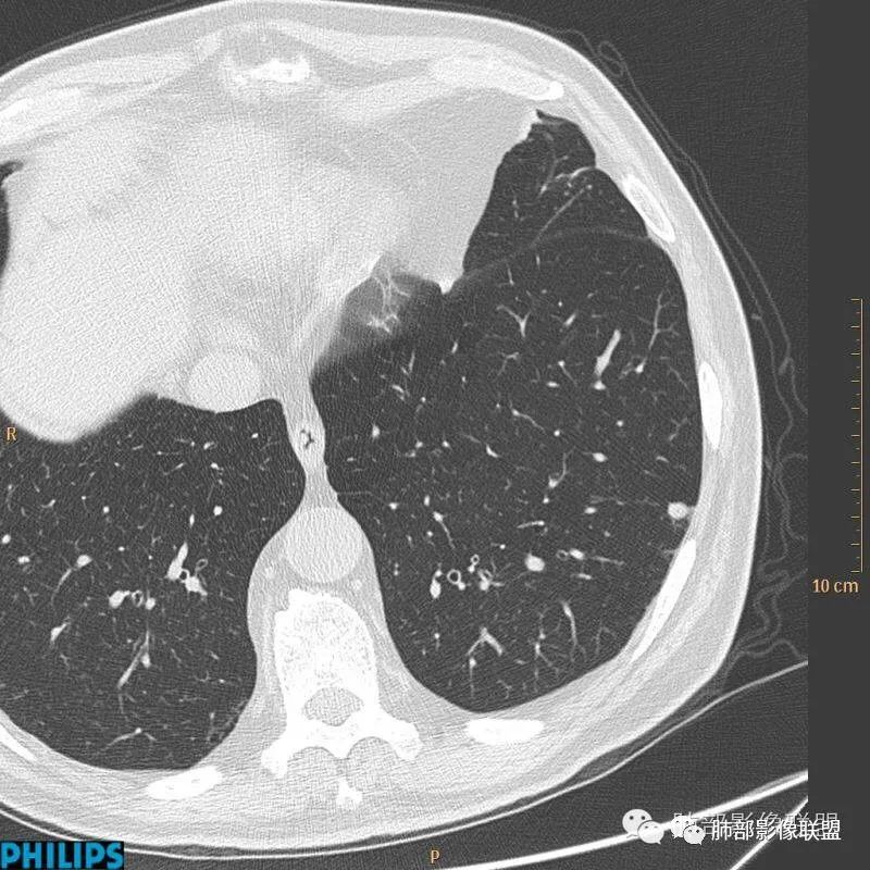 【病例】肺内淋巴结7例CT影像诊断要点-6