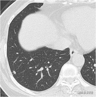 【病例】肺内淋巴结7例CT影像诊断要点-10