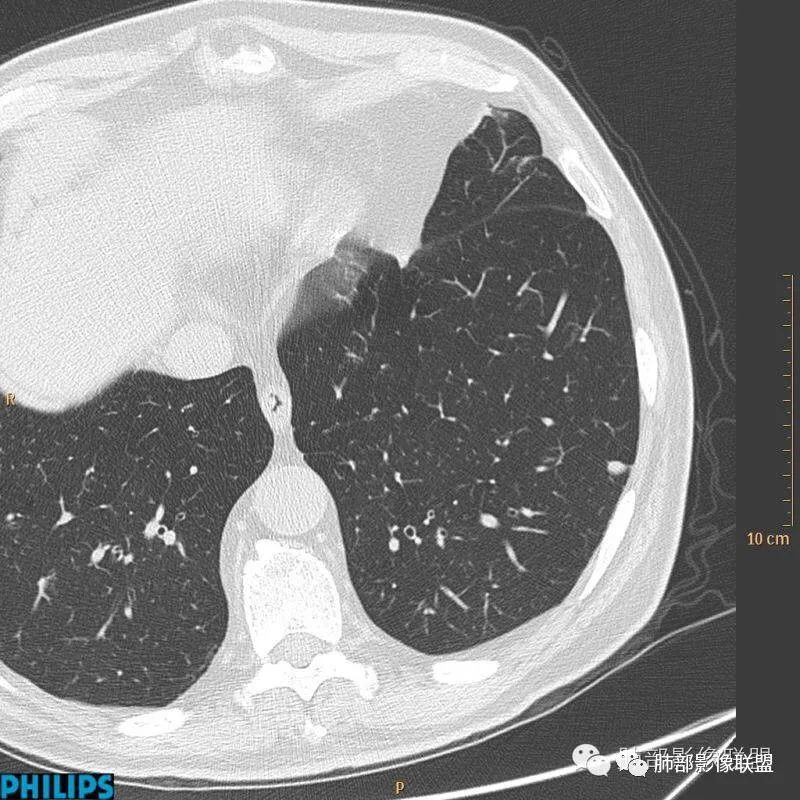 【病例】肺内淋巴结7例CT影像诊断要点-7