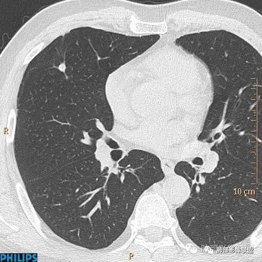 【病例】肺内淋巴结7例CT影像诊断要点-11
