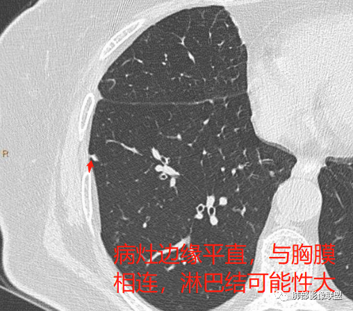 【病例】肺内淋巴结7例CT影像诊断要点-12