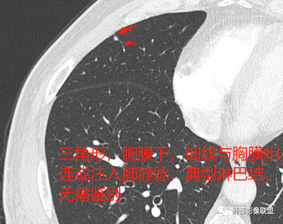 【病例】肺内淋巴结7例CT影像诊断要点-13