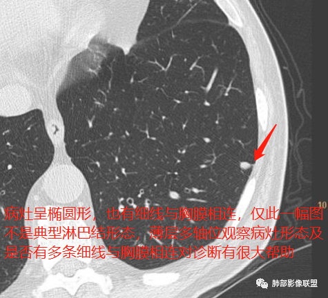 【病例】肺内淋巴结7例CT影像诊断要点-15