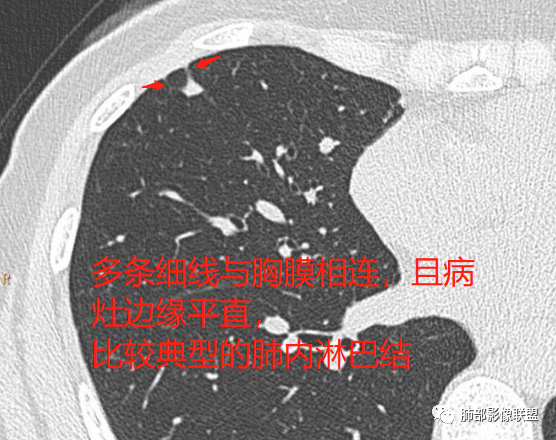 【病例】肺内淋巴结7例CT影像诊断要点-14