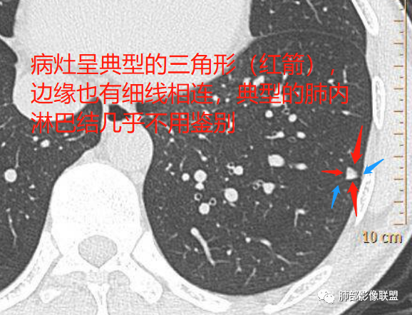 【病例】肺内淋巴结7例CT影像诊断要点-16