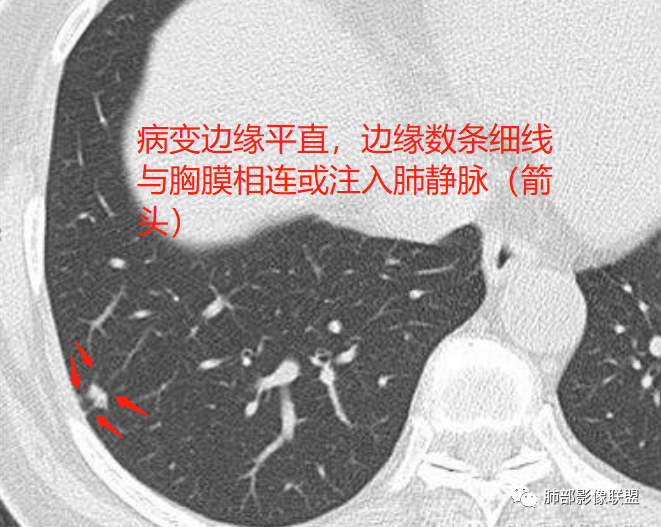 【病例】肺内淋巴结7例CT影像诊断要点-17