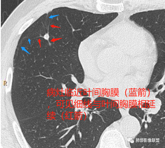 【病例】肺内淋巴结7例CT影像诊断要点-18
