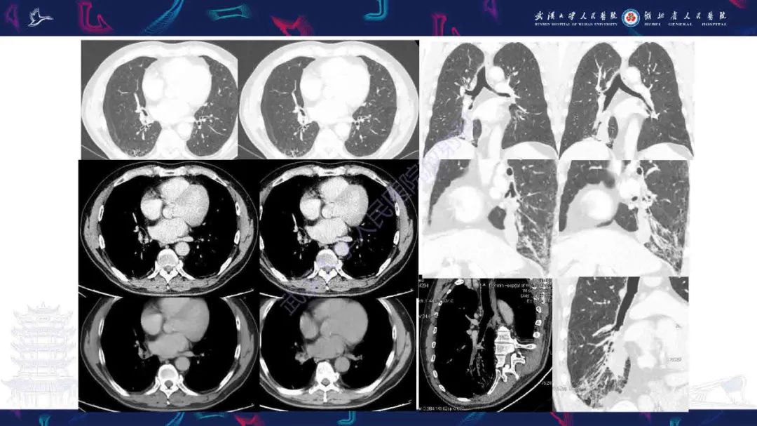 【PPT】成人气管支气管病变影像诊断-3