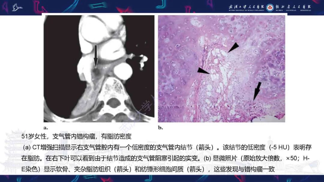 【PPT】成人气管支气管病变影像诊断-9