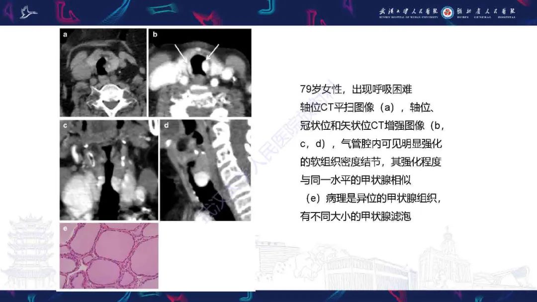 【PPT】成人气管支气管病变影像诊断-11