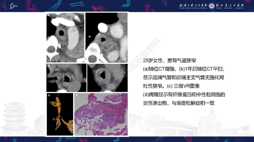 【PPT】成人气管支气管病变影像诊断-13