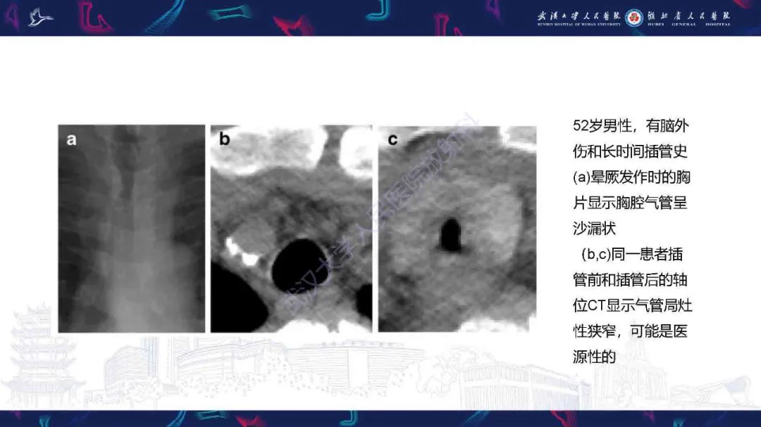 【PPT】成人气管支气管病变影像诊断-15