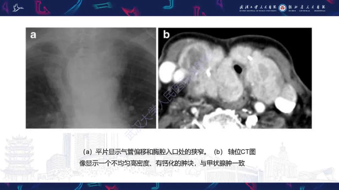 【PPT】成人气管支气管病变影像诊断-17