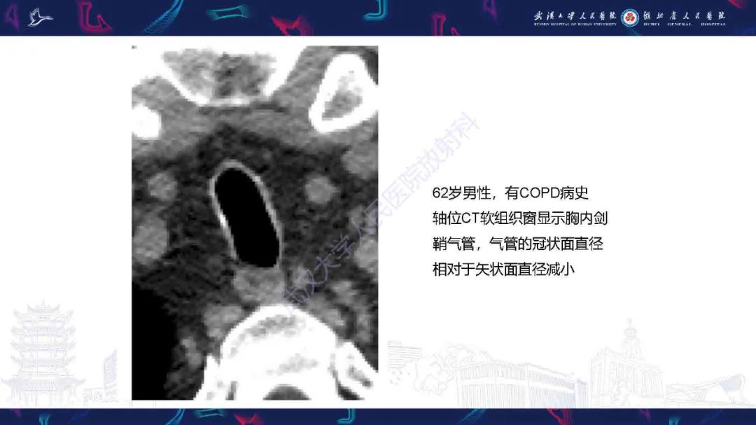 【PPT】成人气管支气管病变影像诊断-21