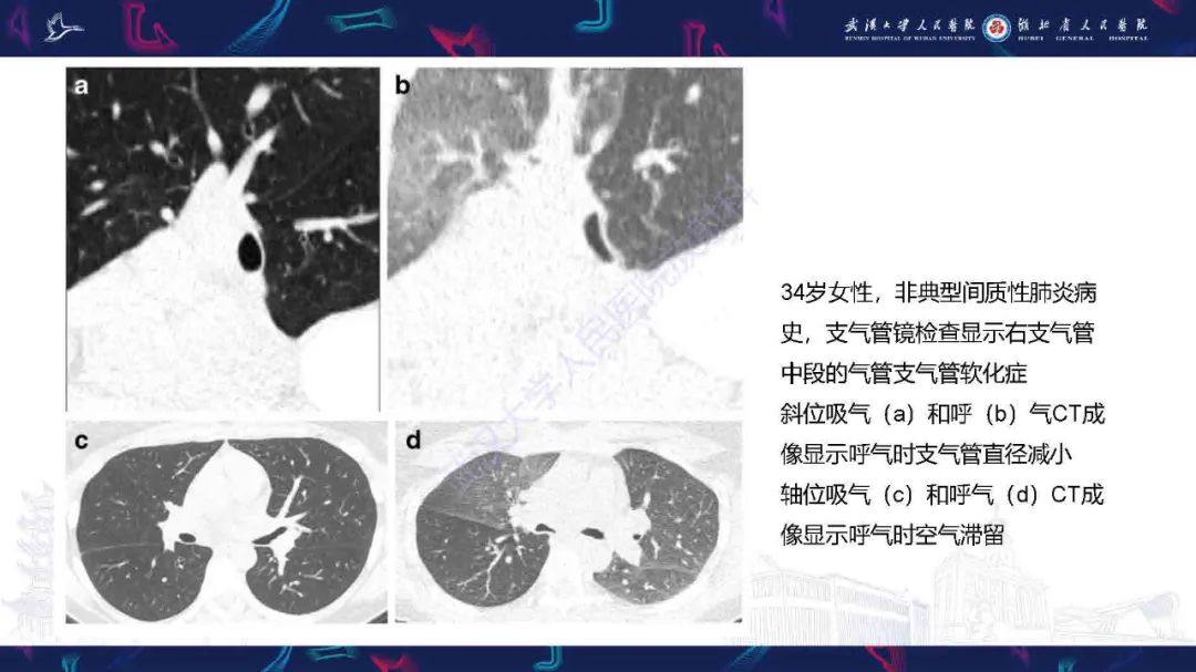 【PPT】成人气管支气管病变影像诊断-23