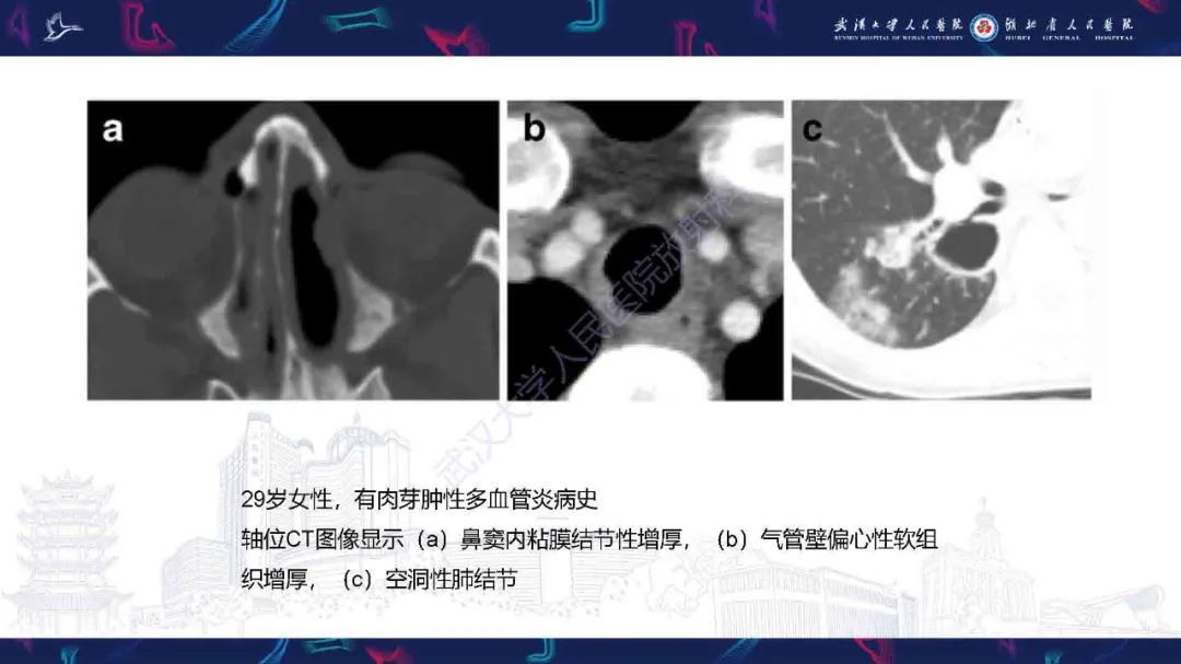【PPT】成人气管支气管病变影像诊断-28