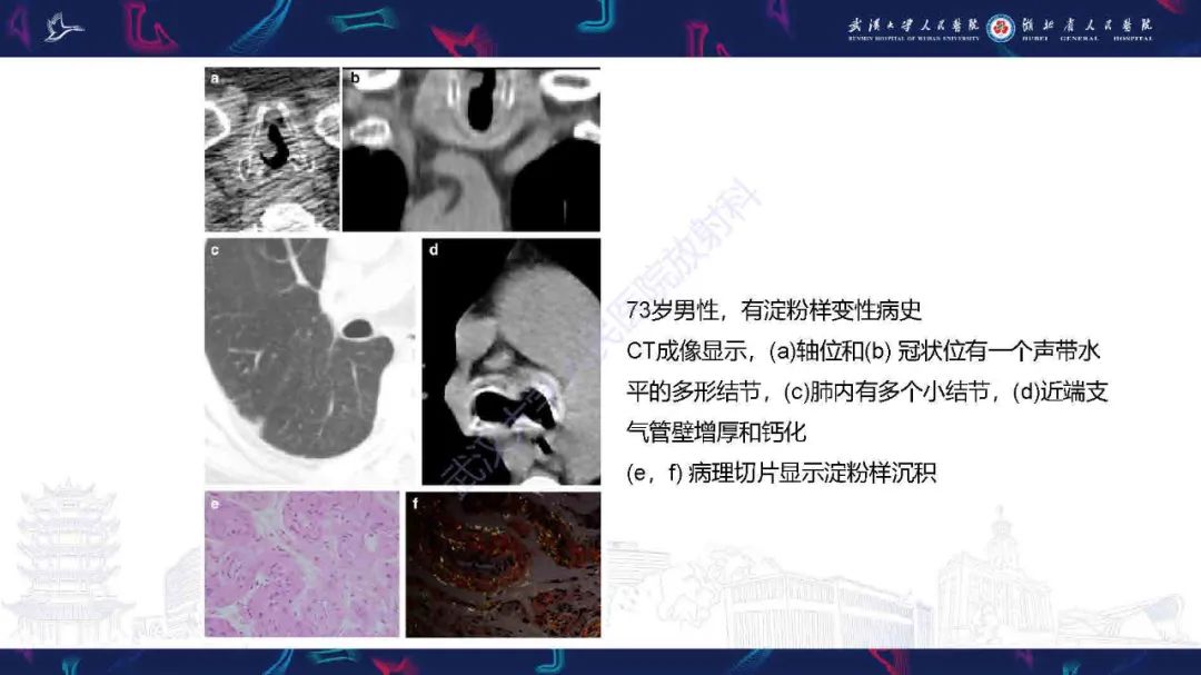 【PPT】成人气管支气管病变影像诊断-30