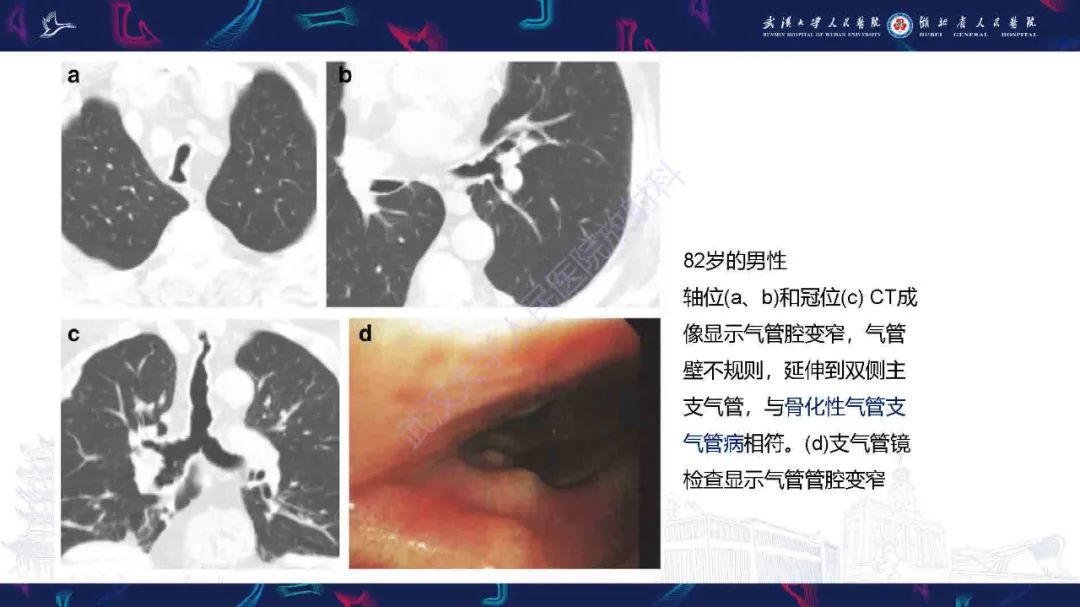 【PPT】成人气管支气管病变影像诊断-32