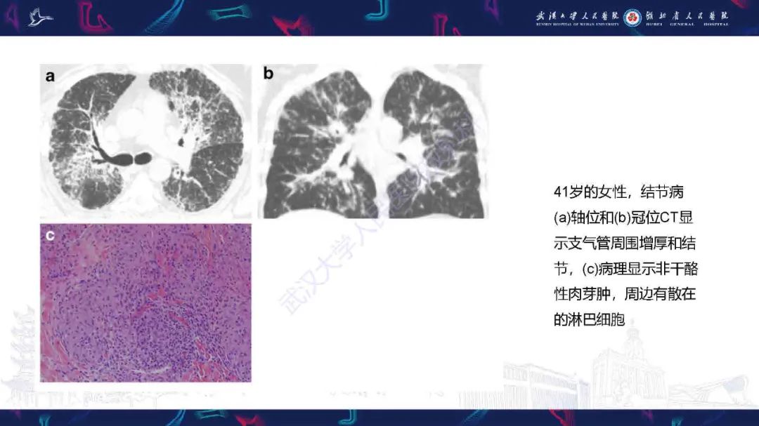 【PPT】成人气管支气管病变影像诊断-34