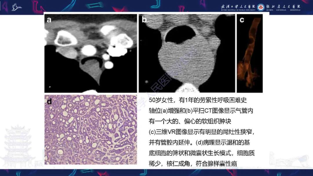 【PPT】成人气管支气管病变影像诊断-38