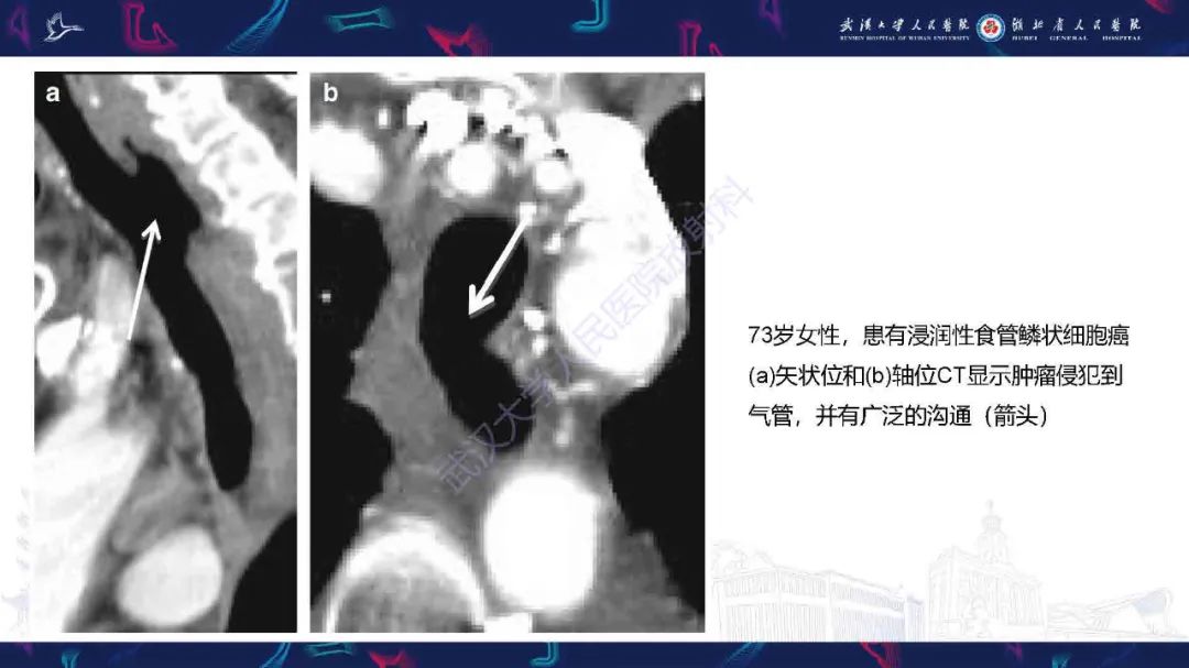 【PPT】成人气管支气管病变影像诊断-40