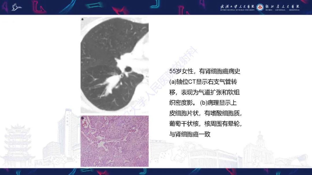 【PPT】成人气管支气管病变影像诊断-41