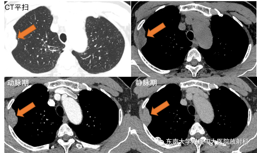 【PPT】胸部孤立性纤维瘤-1