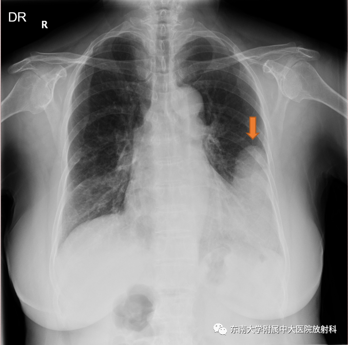 【PPT】胸部孤立性纤维瘤-3