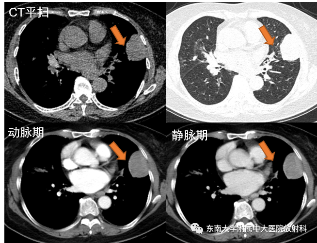 【PPT】胸部孤立性纤维瘤-4