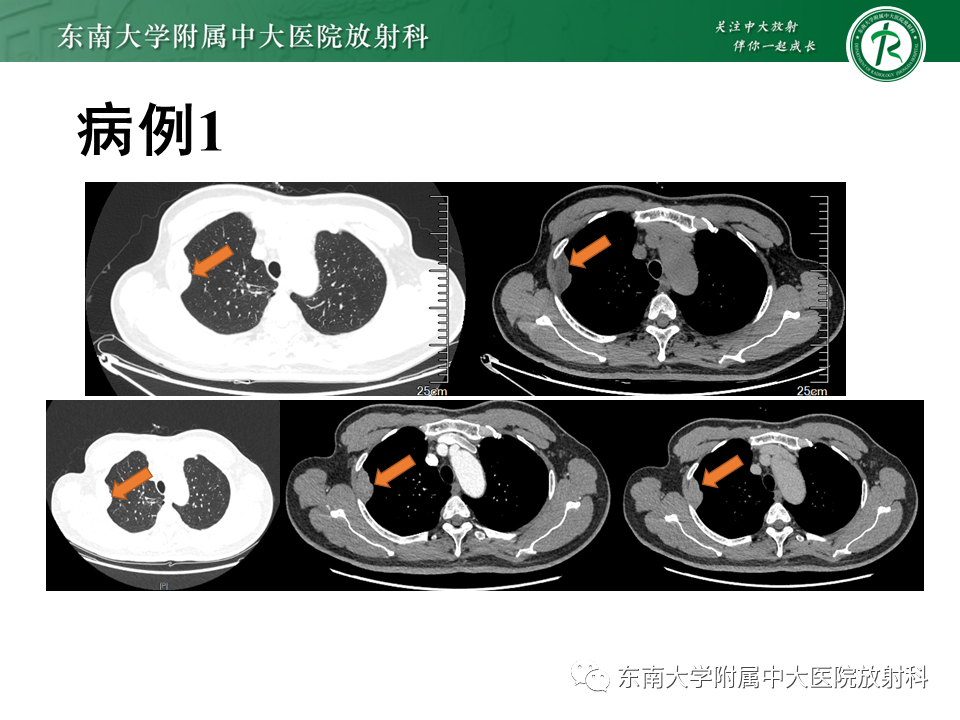 【PPT】胸部孤立性纤维瘤-6