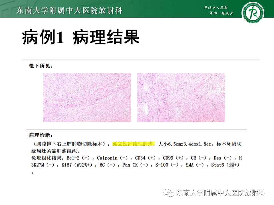 【PPT】胸部孤立性纤维瘤-8