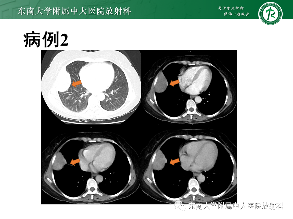 【PPT】胸部孤立性纤维瘤-10