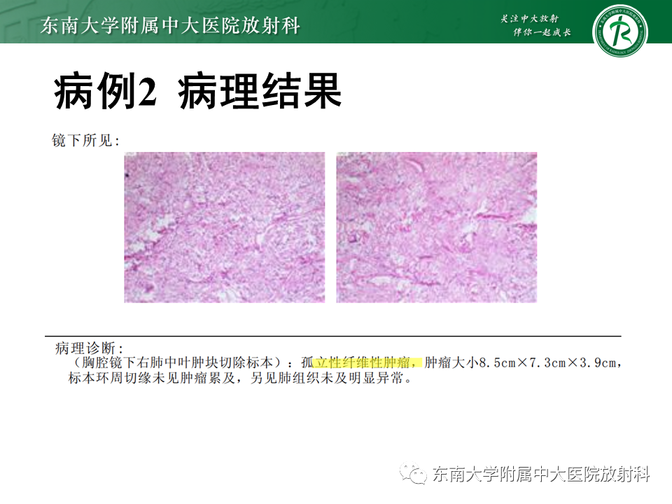 【PPT】胸部孤立性纤维瘤-12