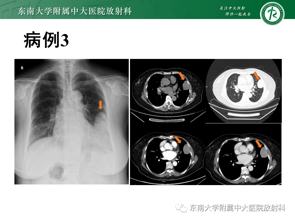 【PPT】胸部孤立性纤维瘤-14