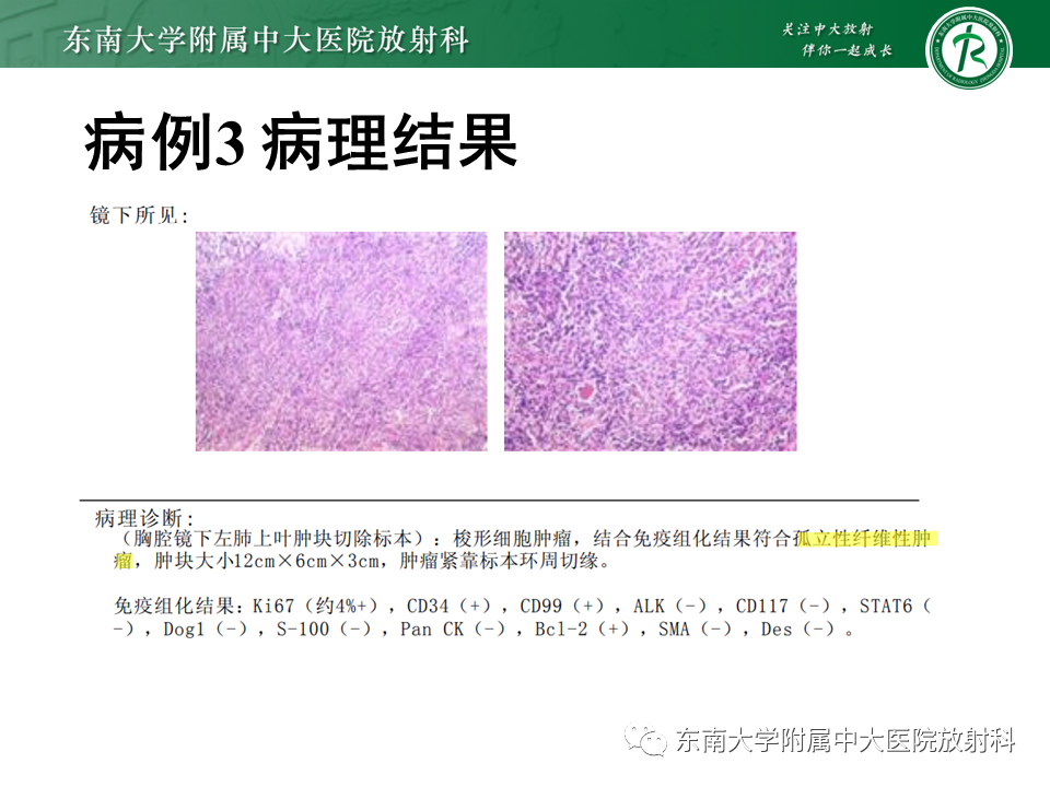 【PPT】胸部孤立性纤维瘤-16