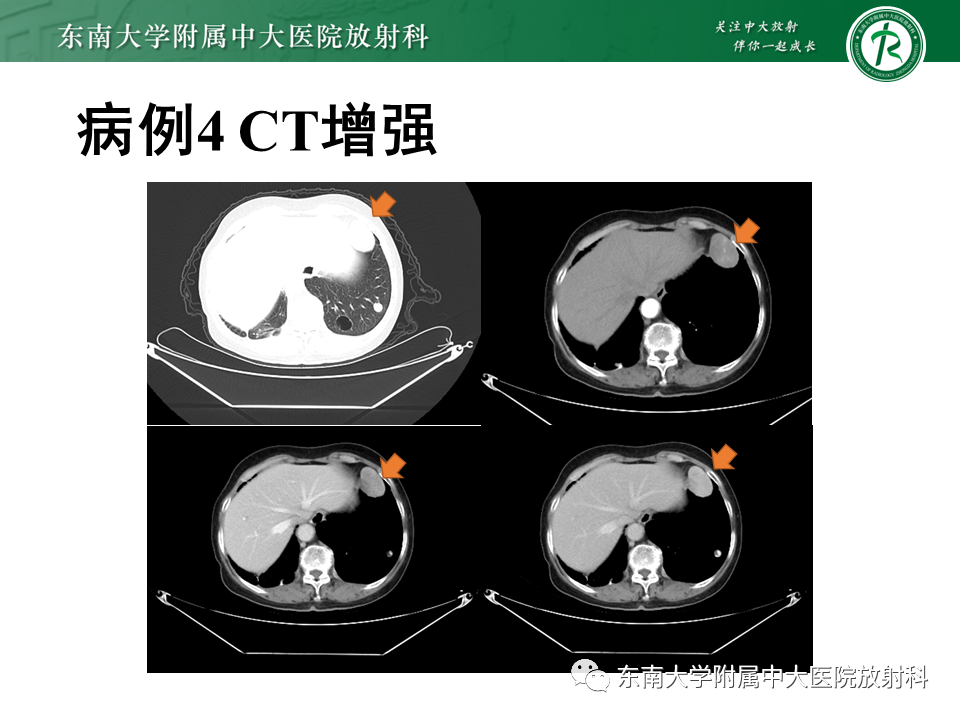 【PPT】胸部孤立性纤维瘤-29