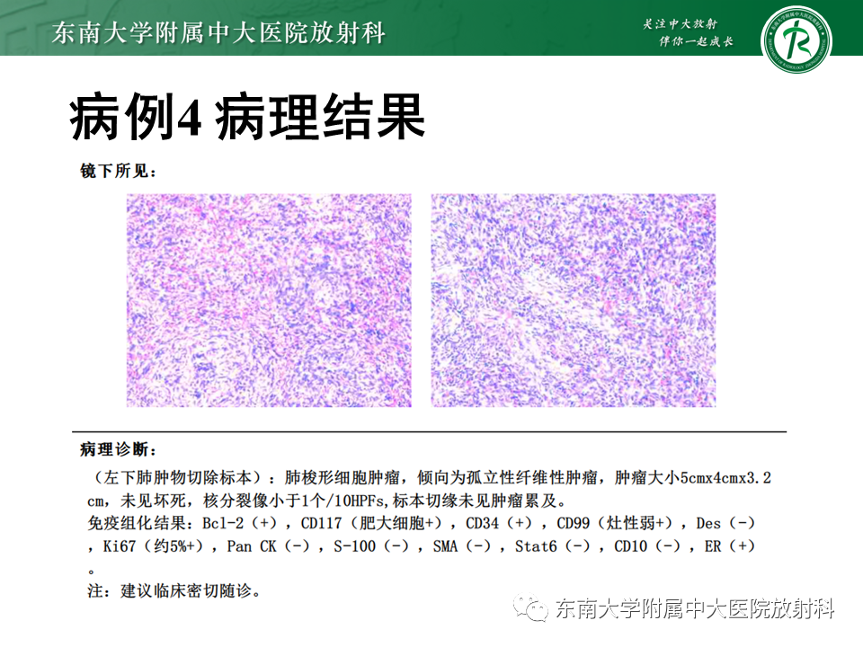 【PPT】胸部孤立性纤维瘤-31