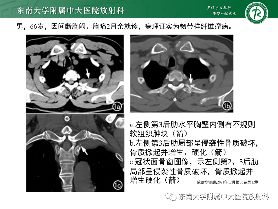 【PPT】胸部孤立性纤维瘤-35