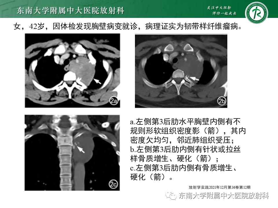【PPT】胸部孤立性纤维瘤-36