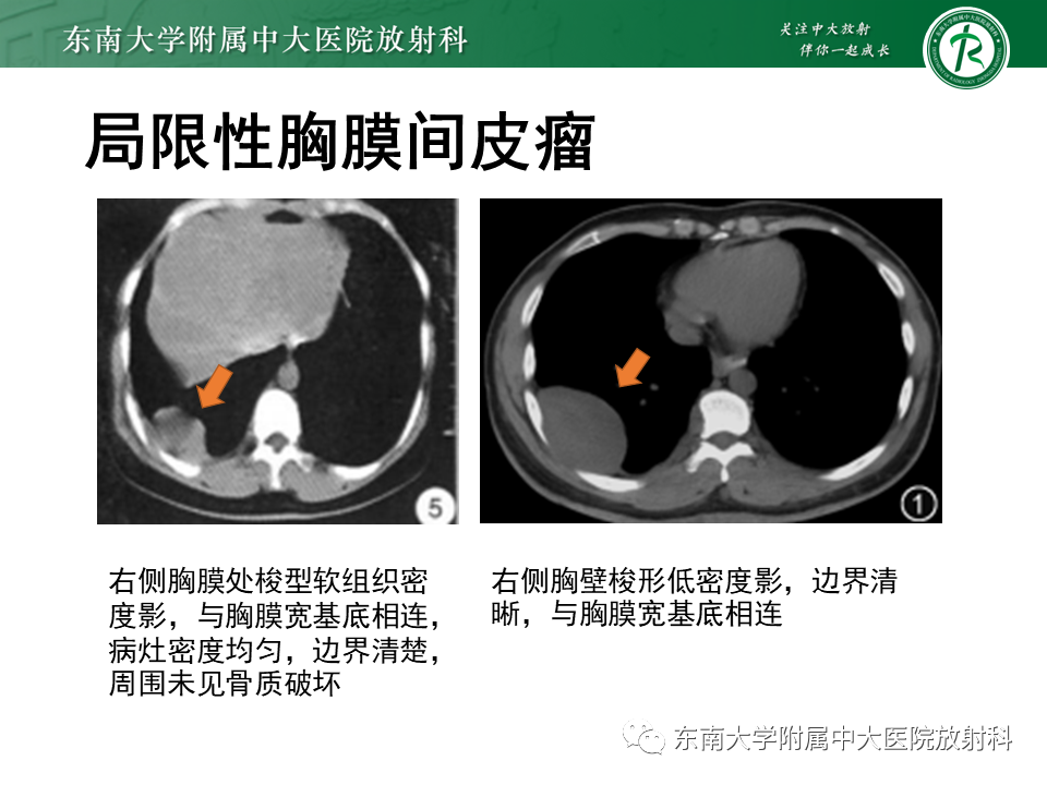 【PPT】胸部孤立性纤维瘤-39