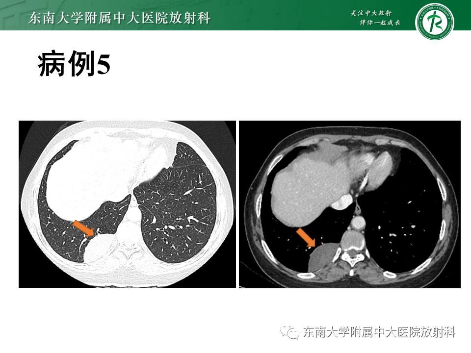 【PPT】胸部孤立性纤维瘤-43