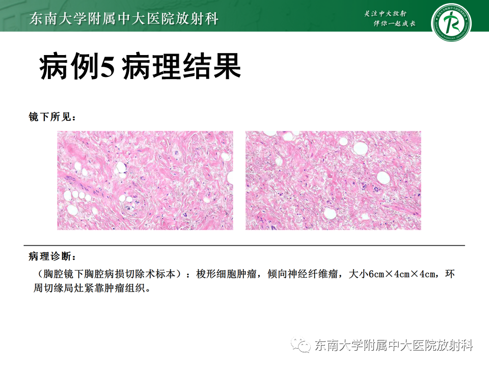 【PPT】胸部孤立性纤维瘤-44