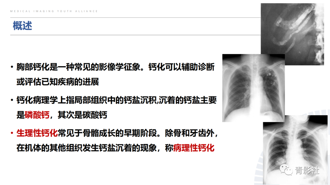 【PPT】胸部钙化临床意义和疾病谱-2